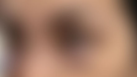 RJ Clinic eyebag treatment consultation showing dark circles and under-eye bags in Kuala Lumpur