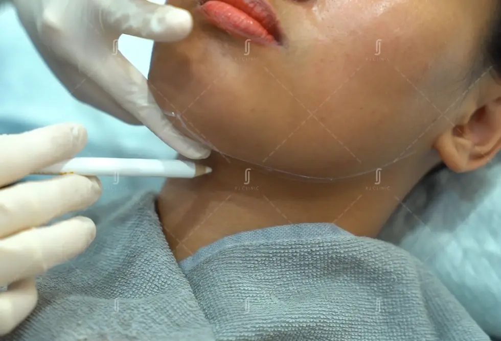 Jawline slimming Botox injection into masseter muscle at RJ Clinic Kuala Lumpur for V shape face contouring