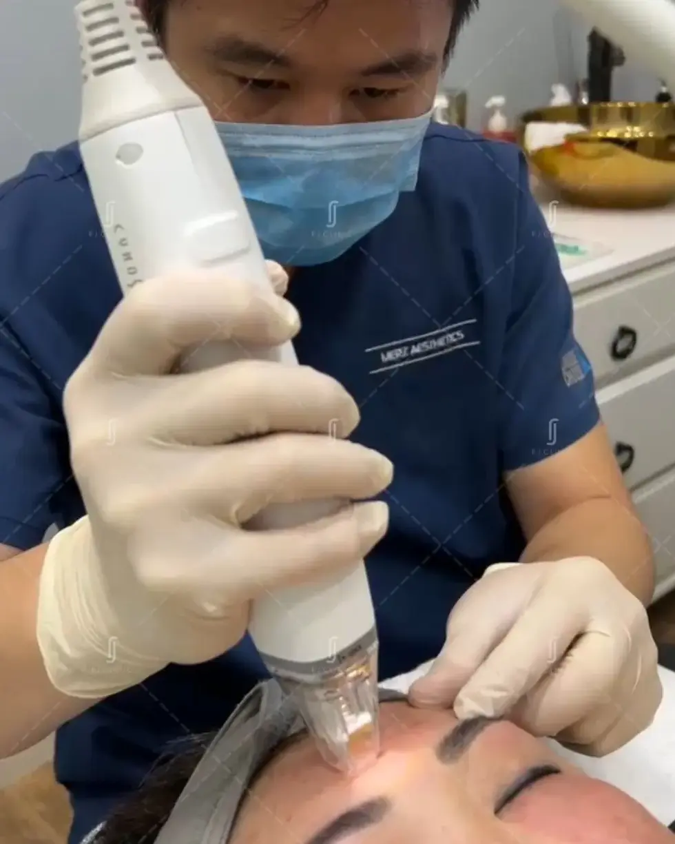 RF microneedling for acne scars performed at RJ Clinic Kuala Lumpur for collagen remodeling