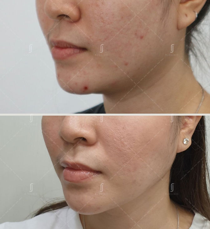 Double Chin Jawline Treatment by RJ Clinic