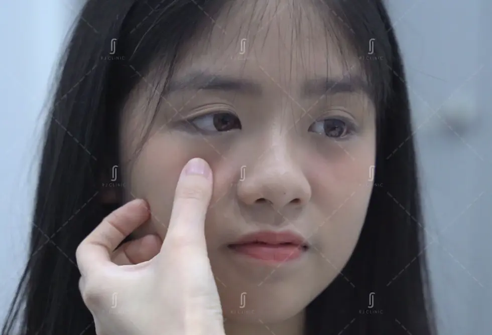 RJ Clinic patient receiving dark eye circle treatment consultation in Kuala Lumpur Malaysia
