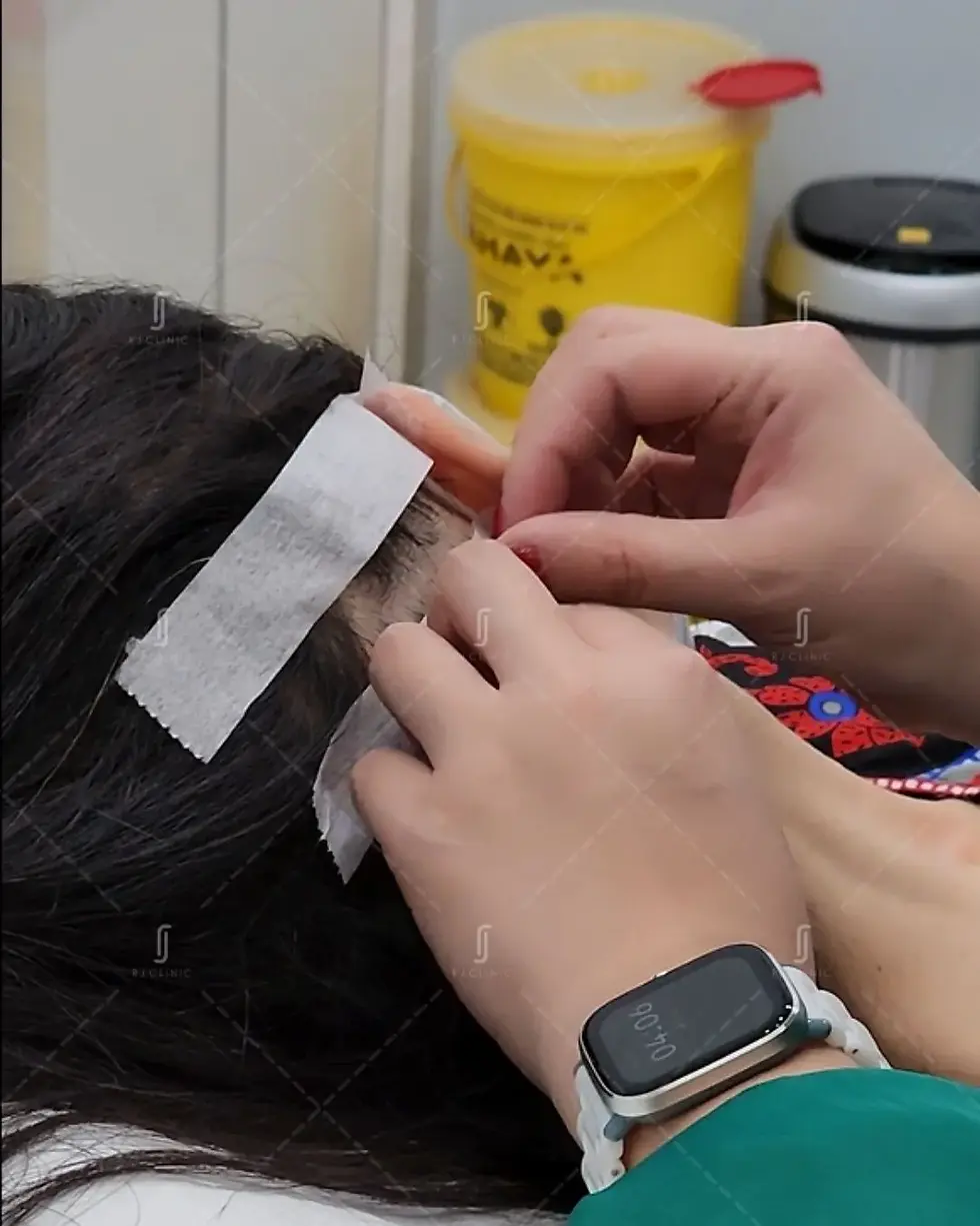Hair loss consultation and scalp assessment at RJ Clinic Kuala Lumpur for stress-related shedding