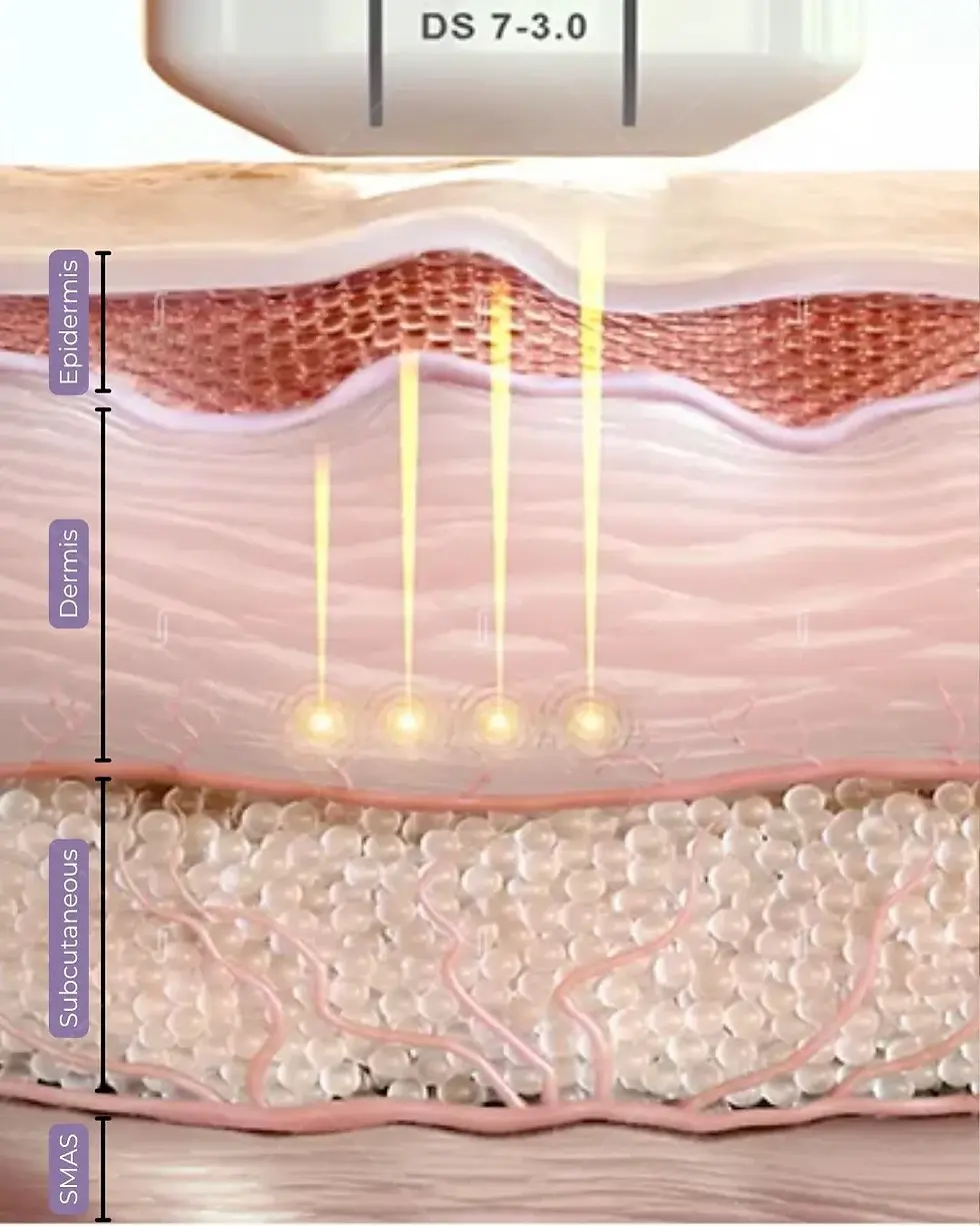 Ultherapy SMAS layer targeting diagram explained by RJ Clinic for deep tissue lifting and collagen regeneration