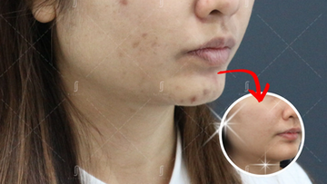 Acne Scar Laser Treatment Cost in Malaysia: A Clinical Reference (2026)