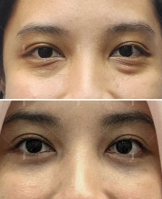 Before and after eye bag removal surgery at RJ Clinic Malaysia – female patient with smoother under-eye area and lifted lower lids.