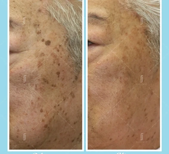 Mole removal at RJ Clinic