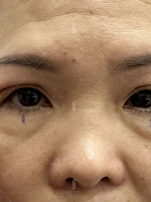 Eyelid assessment for ptosis and monolid at RJ Clinic Kuala Lumpur consultation