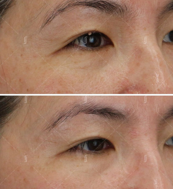 Plexr plasma skin tag removal treatment at RJ Clinic