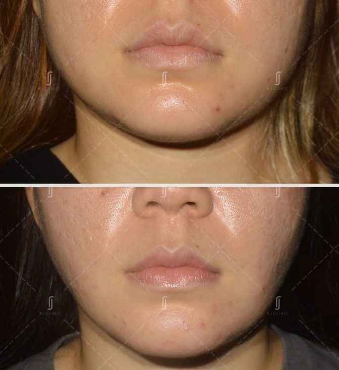 Double Chin Jawline Treatment by RJ Clinic