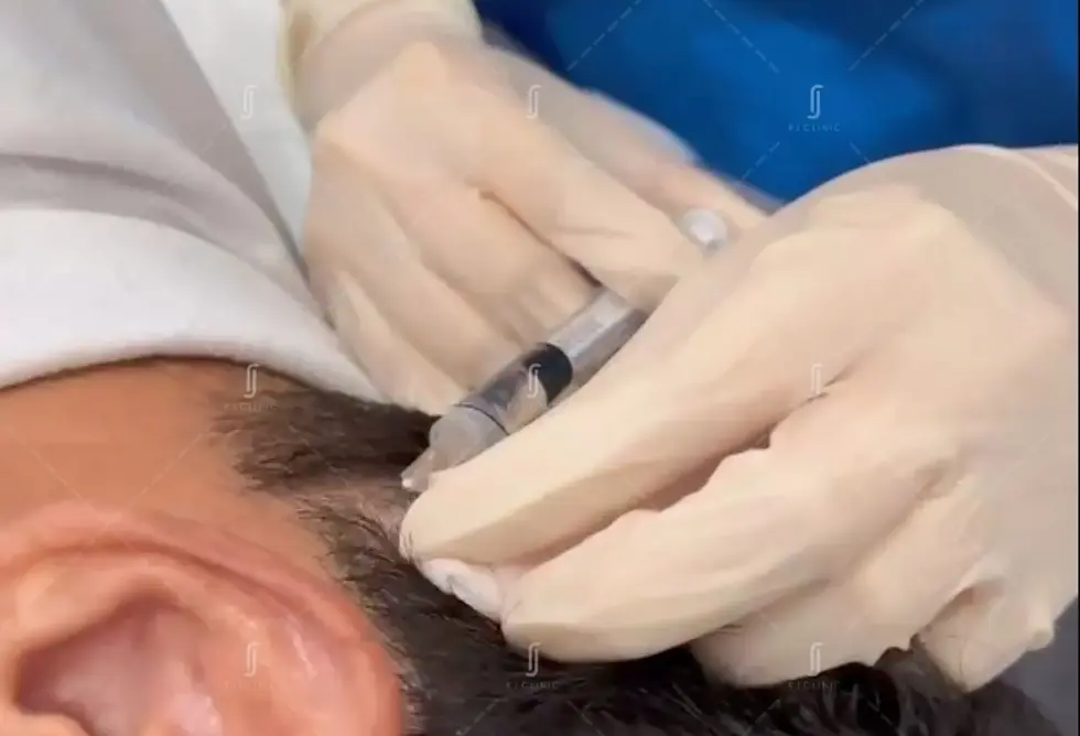 PRP hair injection treatment at RJ Clinic Kuala Lumpur for thinning hair and hair loss