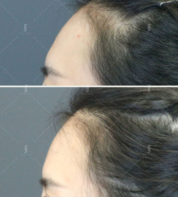 Botox Treatment for forehead at RJ Aesthetic Clinic
