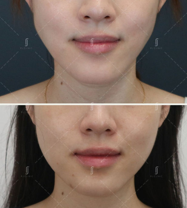 Botox Treatment for masseter at RJ Aesthetic Clinic