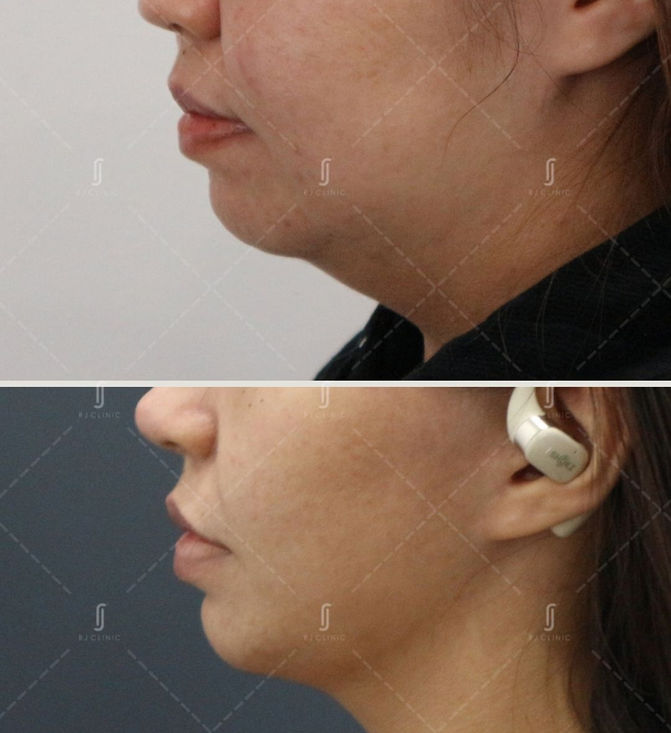 Double Chin Jawline Treatment by RJ Clinic
