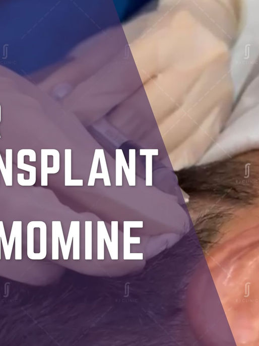 Hair Transplant vs Dermomine Micrograft Therapy