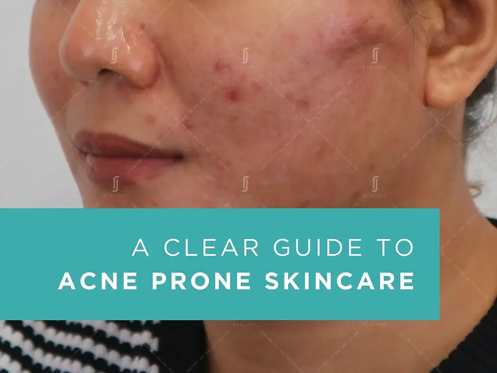 A Clear Guide to Acne Prone Skincare