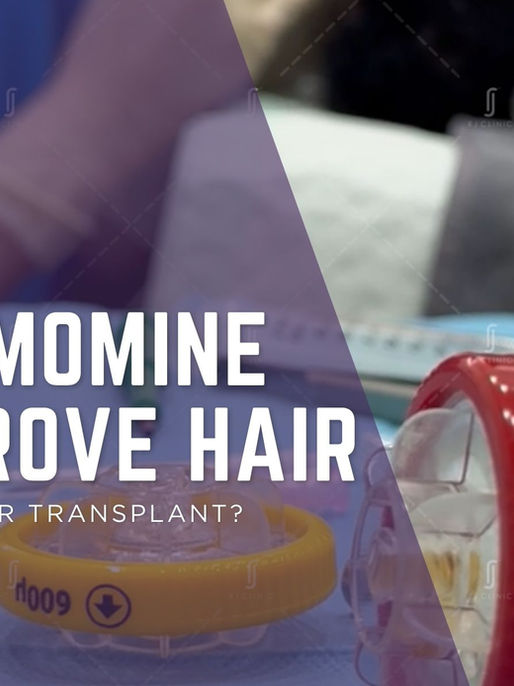 Can Dermomine Improve Hair After Hair Transplant?