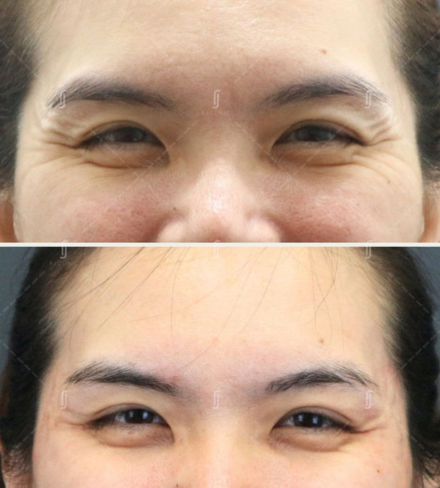 Botox Treatment for crowfeet at RJ Aesthetic Clinic