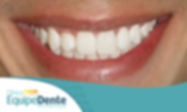Sorriso Branco (Clareado)