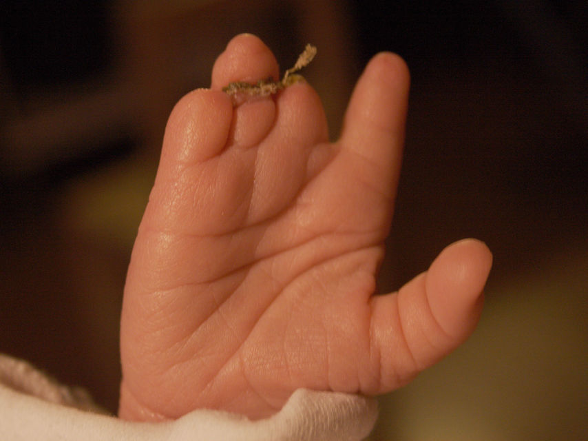 SÍNDROME DE BANDAS AMNIÓTICAS (SBA)