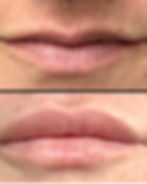 Hyaluronic Acid Lip Filler