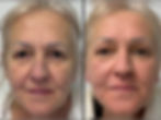 Fibroblast Facelift