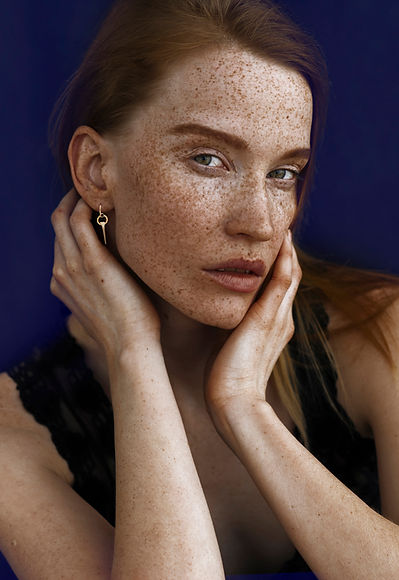 Freckles