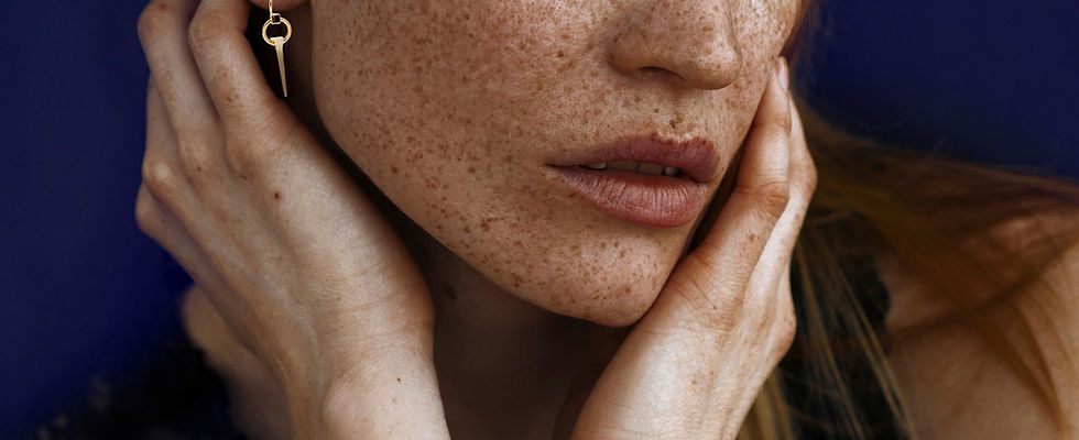 Freckles
