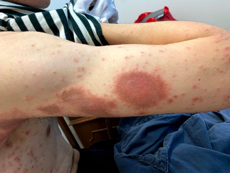 What to do with recurrent eczema and neuro dermatitis?