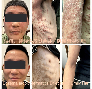 湿疹 神经性皮炎