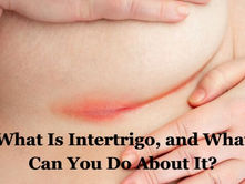 What Is Intertrigo, and What Can You Do About It?