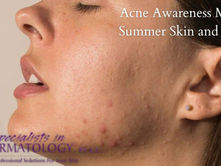 Summer Skin and Acne: What You Need to Know This Acne Awareness Month