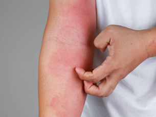 Eczema 101: Understanding the Condition and Your Treatment Options