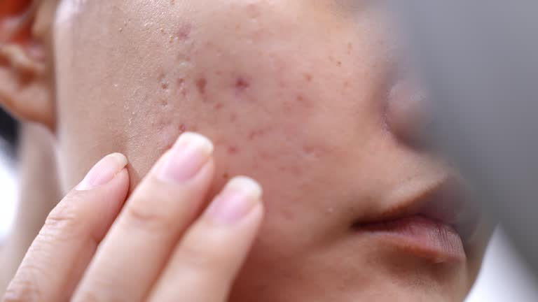 acne and acne scars on face