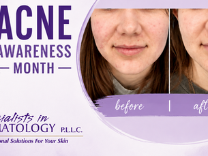 Acne Awareness Month: What Your Skin Is Trying to Tell You