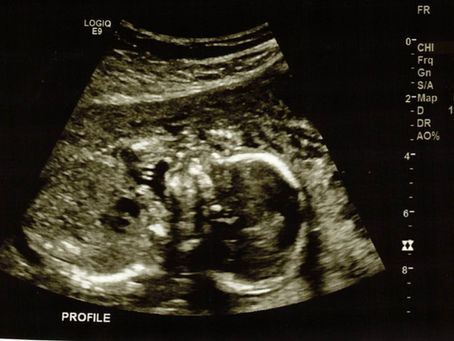 In Her Shoes: Termination for Medical Reasons