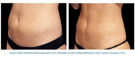 emsculpt-bauch-de-4.jpg