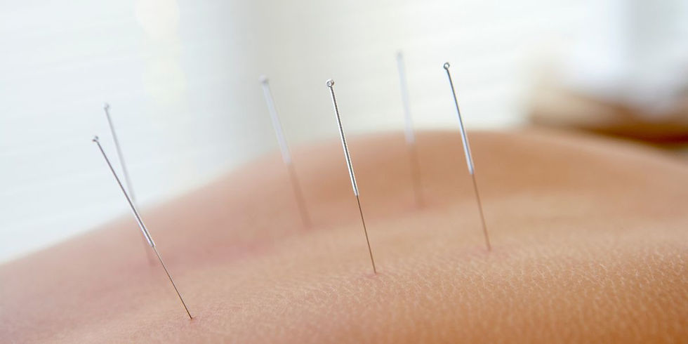 A person enjoying a healing acupuncture treatment