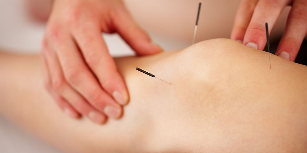 A woman receiving acupuncture for maintenance and illness prevention