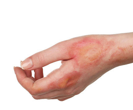 skin-burns-scaled.jpeg