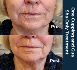 Facial cupping results