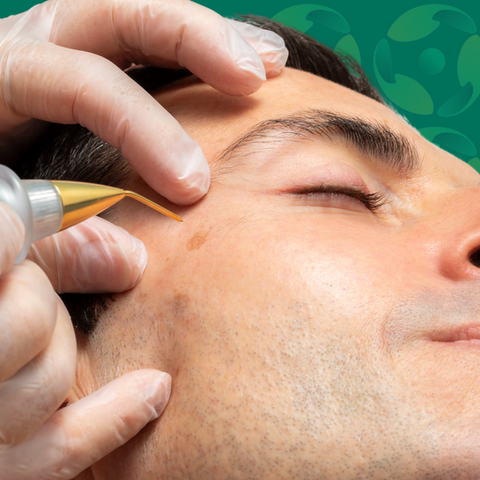 Wart, Lumps, Bumps Removal - Cura Health Belfast 