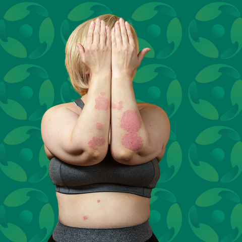 Eczema - Cura Health Belfast 