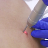laser-removal-Shutterstock-Ekaterina-Vidyasova-300x169.png