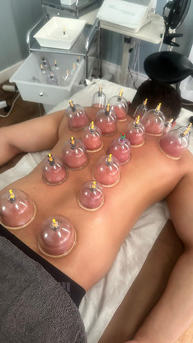 cupping1.jpeg