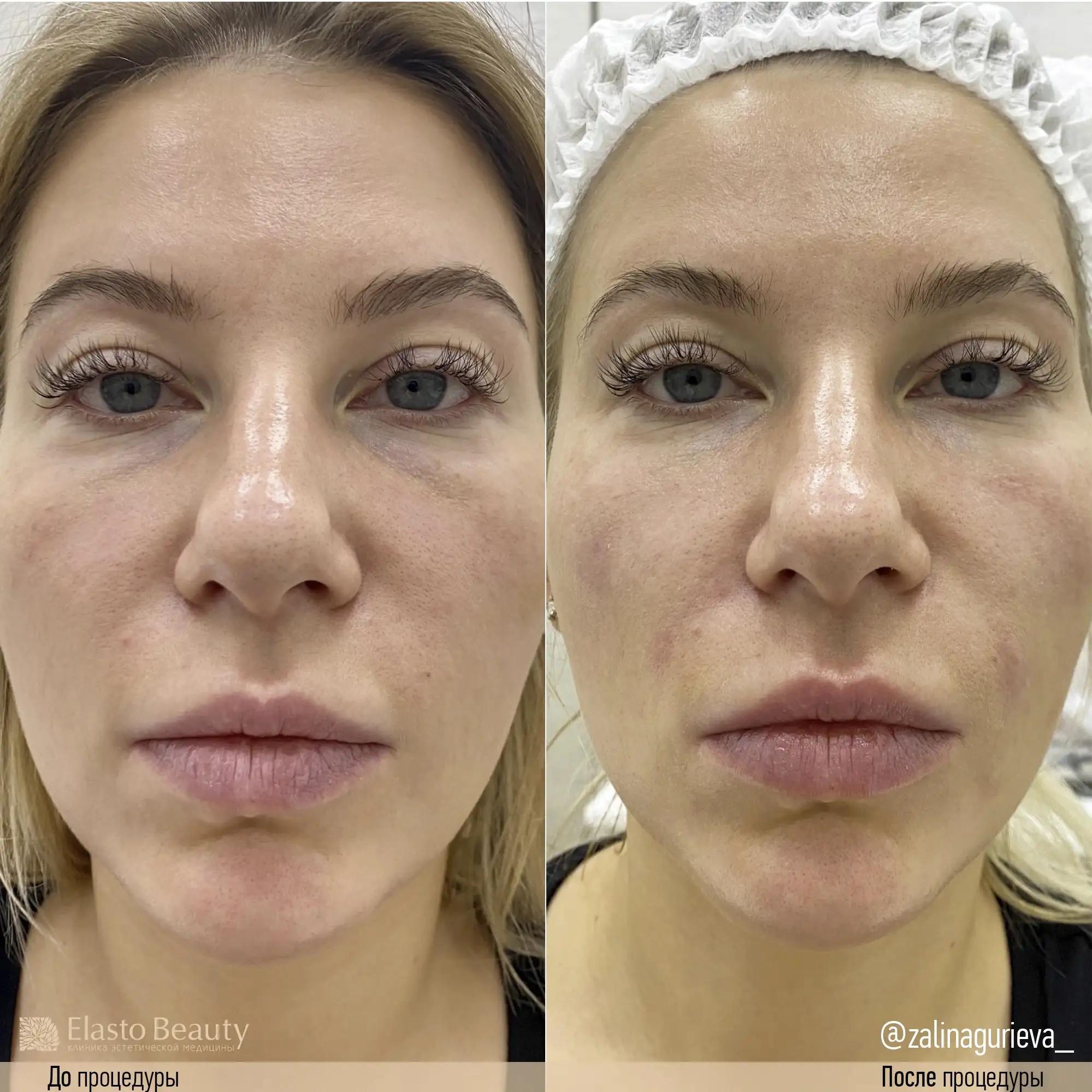ДО И ПОСЛЕ | ElastoBeauty