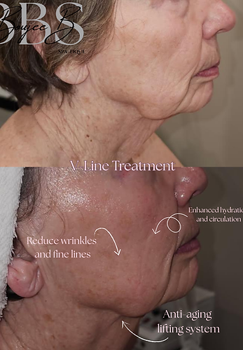 V-Line Treatment (1).png