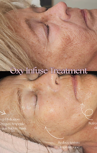 Oxy Infuse Treatment.png