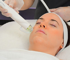 RF Microneedling on Ladies Cheek.JPG