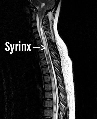 Syringomyelia