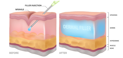 Dermal Filler Diagram